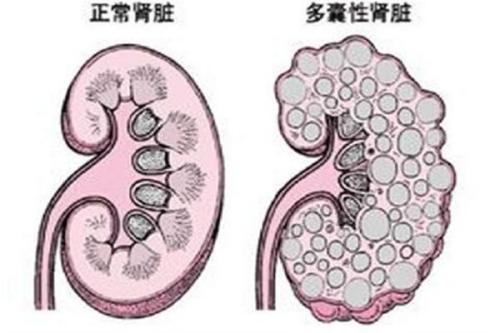 多囊肝多囊肾最新治疗进展及策略综述